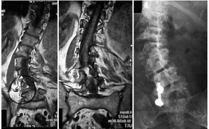 Fig. 11 A 79-year-old female patient, known to have scoliosis since late twenties. Persistent L5 radiculopathy after selective foraminal decompression 4 years ago