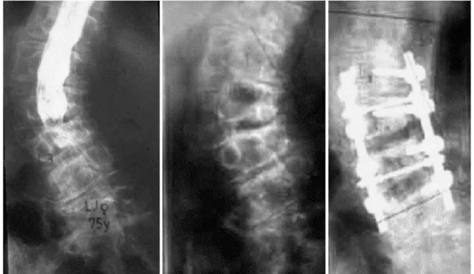 Fig. 12 A 75-year-old actress with subacute paraparesis, no relevant back pain: decompression, stabilization, and fusion in situ