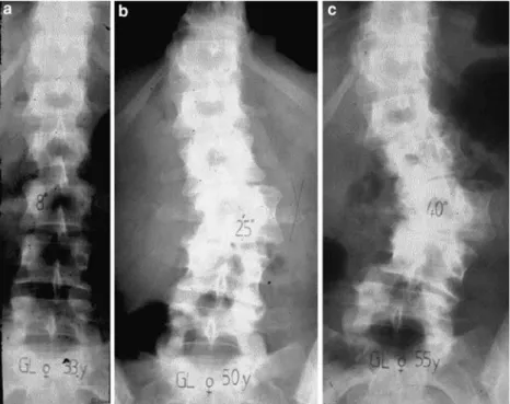 Fig. 1 Type 1 adult scoliosis: de novo scoliosis. a at 33 years (8°), b at 50 years (25°), c at 55 years (40°)
