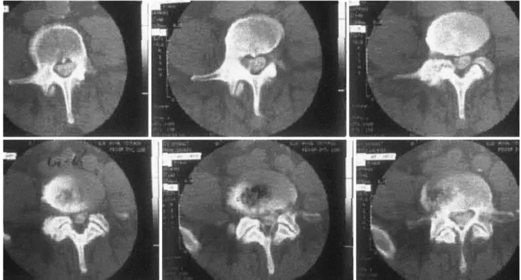 Fig. 2 Secondary changes in degenerative scoliosis: facet joint hypertrophy, recessal stenosis