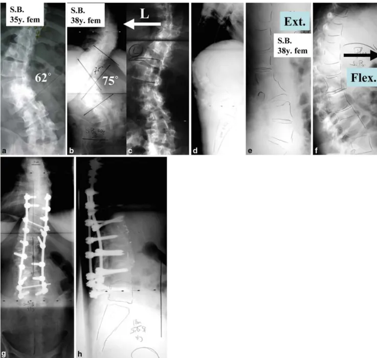Fig. 3 Young female teacher with progressive idiopathic scoliosis.