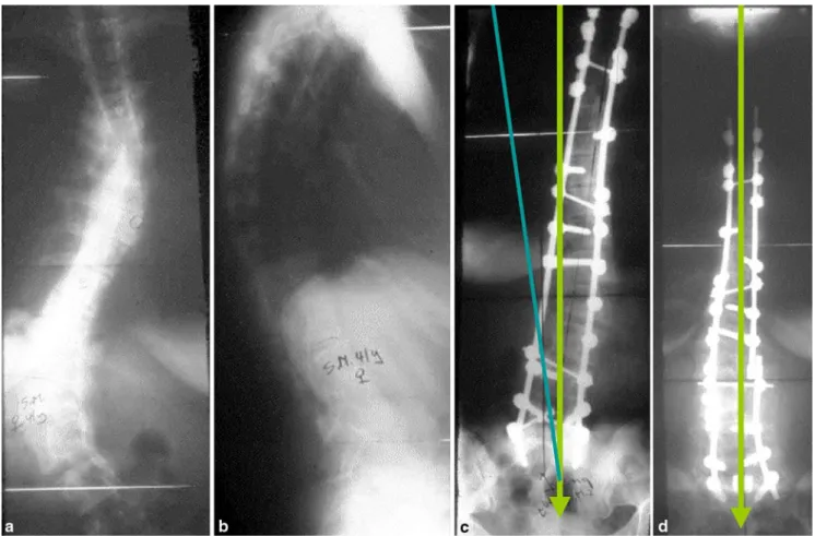 Fig. 4 a and b Double major idiopathic scoliosis in a 41-year-old female patient with increasing back pain in the last few years and subjective progression of the curve