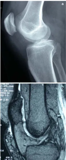 Fig. 1 Patellotrochlear index measurement 4 .: BL P Baseline patella (2 superior most aspect of articular cartilage to 3 inferior most aspect); BL T : Baseline trochlea (length of trochlear articular surface from 1 superior most aspect with respect to 3 th
