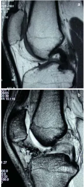 Fig. 5 Sagittal MR shows short trochlea and relatively short osseous sagittal diameter of the patella compared to the articular cartilage