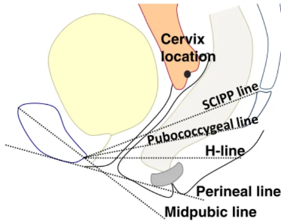 Fig. 1 The five most commonly used reference lines. SCIPP sacrococcygeal – inferior pubic point line, H-line horizontal line
