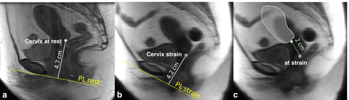 Fig. 4 Localization of the cervix using the perineal line system in a woman a at rest and b at maximum strain