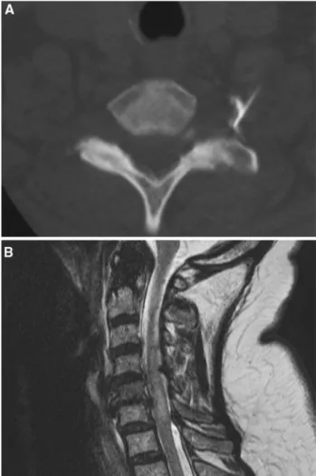 Fig. 1 Imaging studies of a 71 year old female (Case 1). a C7/T1 foraminal injection on the left side