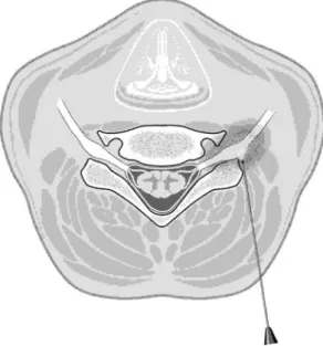 Fig. 3 The patient is positioned supine and the needle is advance to the lateral and anterior aspect of the facet joint