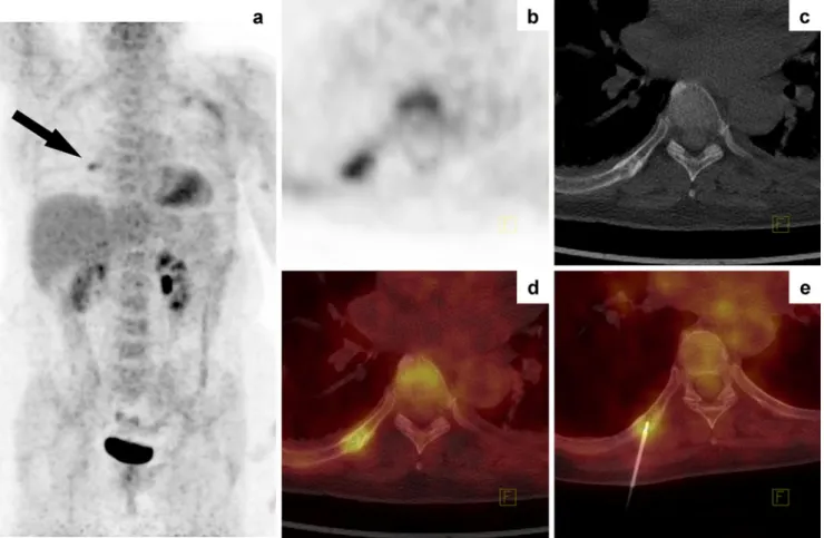 Fig. 3 A 61-year-old patient with operated breast cancer. PET/CT staging showed a moderately FDG-avid lesion in the 8th rib on the right with an indeterminate morphological appearance