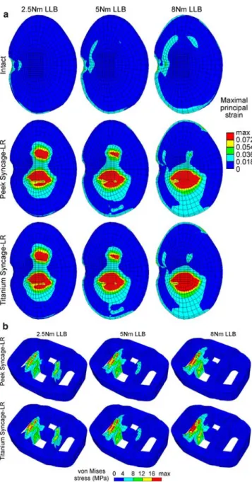 Fig. 6 a Maximal principal strain in the inferior endplate of L2 due to left lateral bending