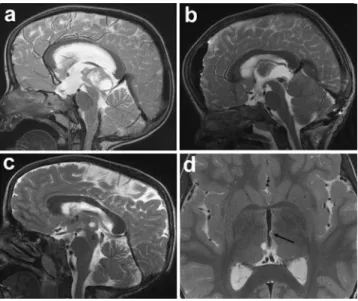 Fig. 1 a Sagittal preoperative T2-weighted MRI showing a cerebral mass with cystic portions located in the pineal region