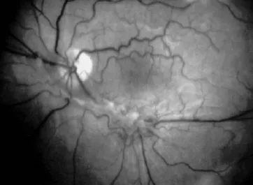 Fig. 1 Isodose curves on a computed tomographic scan, revealing the irradiation field for each eye