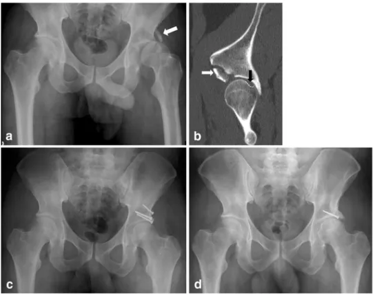Table 4 Radiologic assessment: radiological occurrence of osteoar- osteoar-thritis (OA), avascular necrosis (AVN) or heterotopic ossifications (HO), overall evaluation by the Epstein criteria at the latest follow up (FU) in years
