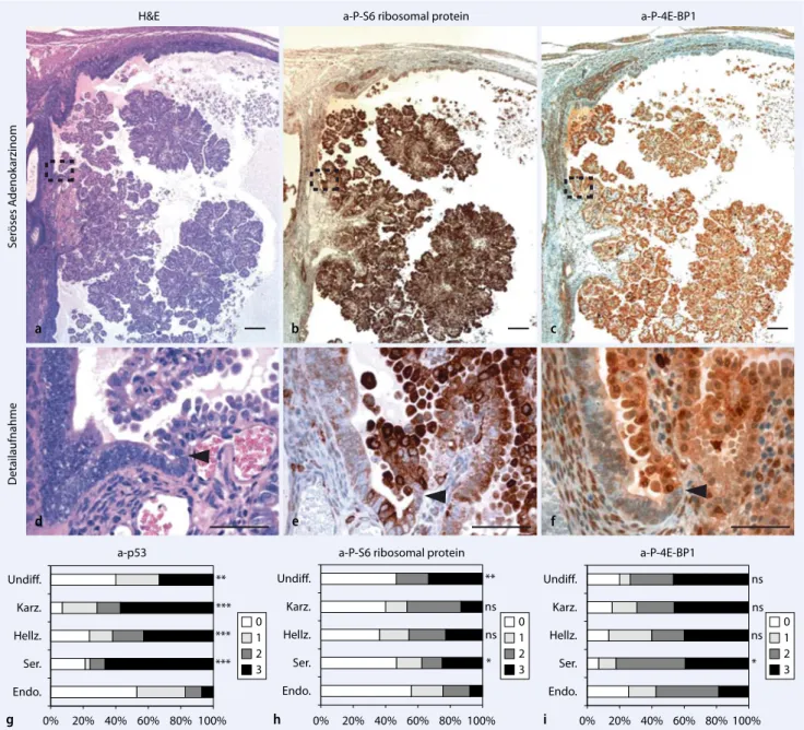Abb. 3  8  a–f Hochregulation von P-S6 und P-4E-BP1 an der Übergangszone eines serösen Adenokarzinoms im Mausmodell