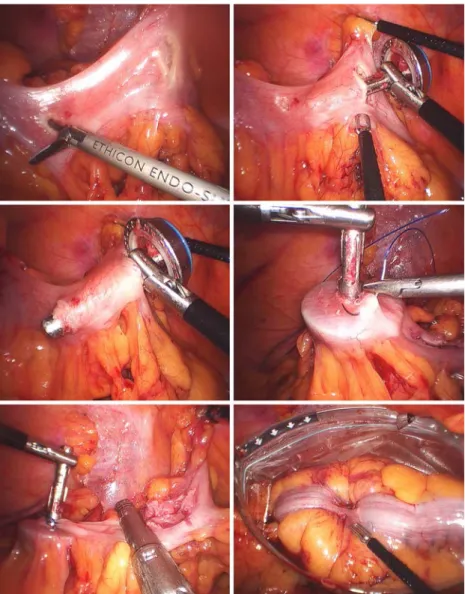 Fig. 2 Intraoperative view during totally intracorporeal laparoscopic colorectal anastomosis preparation