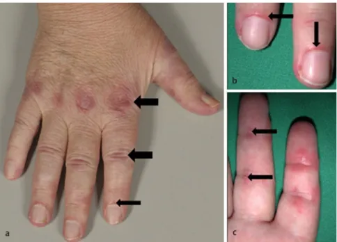 Abb. 1  8  Hautveränderungen einer Patientin mit Dermatomyositis: a Gottron-Papeln dorsal über den  Fingergrund- und Mittelgelenken (dicke Pfeile) und periunguale Rötungen (schmaler Pfeil), b  periun-guale Rötungen in größerer Auflösung (Pfeile), c palmare