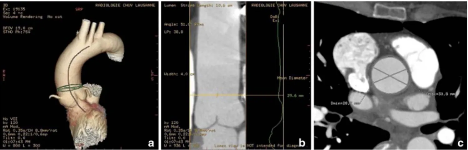 Fig. 3 Three-cavities view demonstrates the fibrous continuity (black asterisk) extending from the left coronary cusp (white asterisk) to the insertion of the anterior leaflet (white circle) of the mitral valve