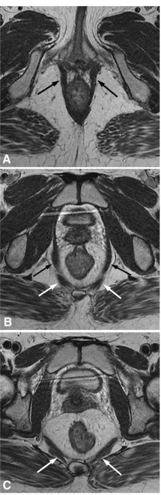 Fig. 1. Axial T2-weighted fast spin-echo images show a normal pelvic diaphragm of a 29-year-old female patient