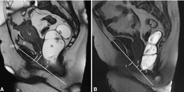 Table 3. Staging of pelvic organ prolapse with the midpubic line (MPL)