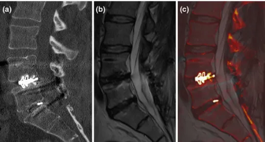 Fig. 1 An image fusion example between sagittal reformatted CT and sagittal T2-weighted MR images