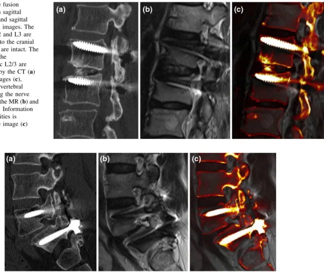 Fig. 3 An image fusion example between sagittal reformatted CT and sagittal T2-weighted MR images