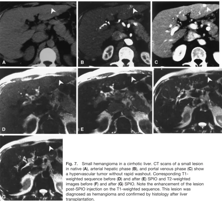 Fig. 7. Small hemangioma in a cirrhotic liver. CT scans of a small lesion in native (A), arterial hepatic phase (B), and portal venous phase (C) show a hypervascular tumor without rapid washout