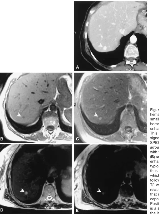 Fig. 4. Small hypervascular hemangioma. A CT shows a small focal lesion with homogeneous contrast enhancement (arrowhead).