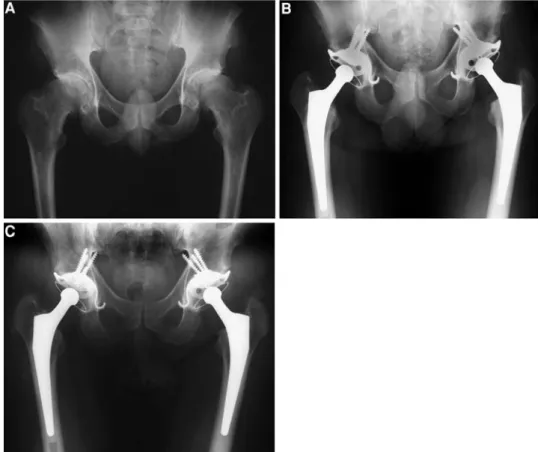 Fig. 2 a A 43-year-old male  with advanced bilateral  osteoar-thritis; b Subsequent  bilaterater-al THA with an ARRH and  Mueller-type straight stem with  22-mm head; c Follow-up at  12 years with an excellent  clini-cal result on both sides (Merle  d’Aubi