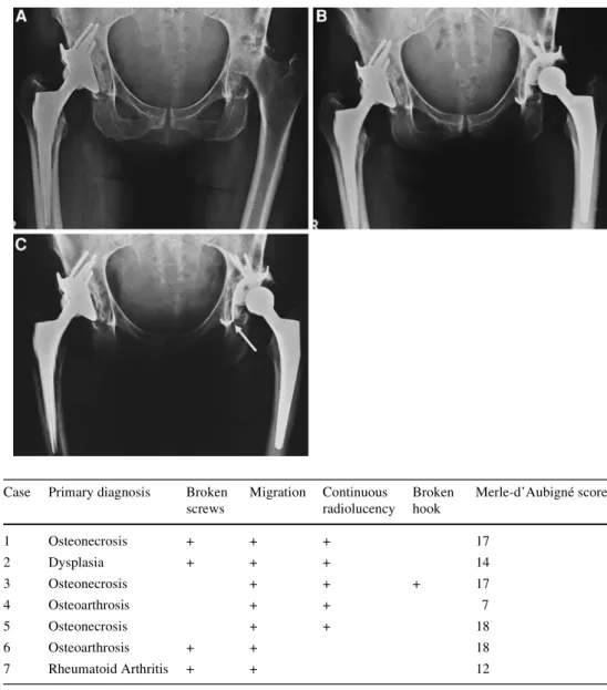 Table 2 Details of cases with  evidence of radiographic  loosen-ing