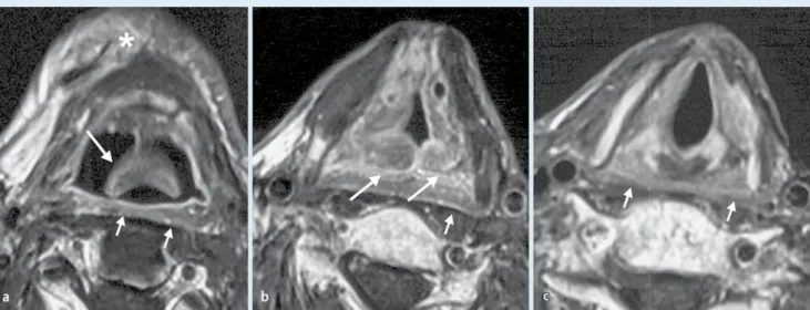 Abb. 19  9  Äußere Laryngozele, bedingt durch  einen supraglottischen Tumor. a, b Luftgefüllte  äußere Laryngozele, die sich zwischen Hyoid  und Schildknorpel in die Halsweichteile rechts  erstreckt (lange Pfeile), axiale T2-FSE-Bilder. Die  Ursache in die