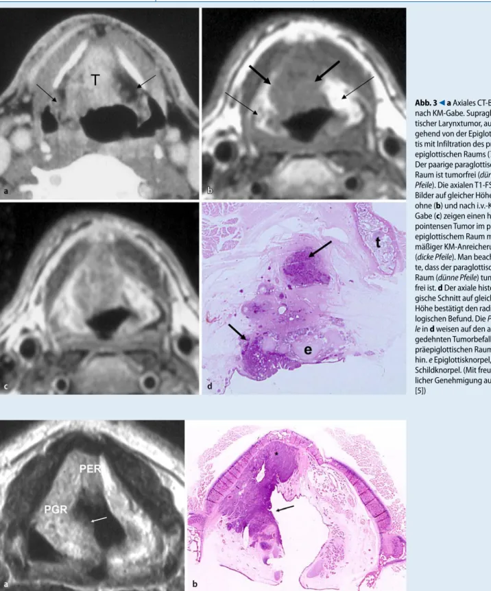 Abb. 4 8 a Axiales KM-angereichertes T1-FSE-Bild auf Höhe der Supraglottis und der dazu gehörende histologische Schnitt  auf gleicher Höhe (b). Endoskopisch wurde bei diesem Patienten ein kleiner Tumor im Bereich der rechten Taschenfalte und  der ventralen
