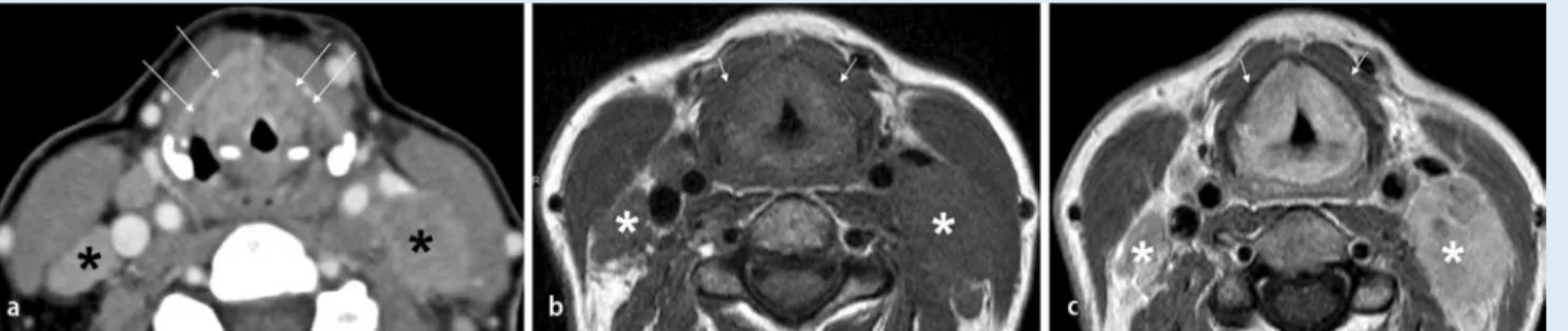 Abb. 9  8  a Axiales KM-angereichertes CT-Bild auf Höhe der Subglottis und der dazu gehörende histologische Schnitt auf  gleicher Höhe (b). Primär subglottischer Larynxtumor (T) mit zirkumferentieller Einengung der Subglottis und ausgedehnter  Destruktion 