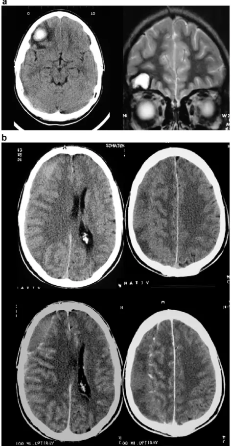 Fig. 2 a Serial axial CT and coronal T2-weighted MRI in a 22-year-old male with a  fronto-basal contusion