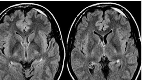 Fig 3 Axial FLAIR images in a 24-year-old male with an acute small SDH. The suppression of the CSF signal enhances  detec-tion of the frontal  FLAIR-hy-perintense SDH