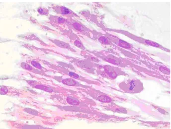 Fig. 2 Histologically the morphology of the cells was the same in all examined specimens: sheets of plump spindle cells with occasional mitotic figure (original magnification · 400;  hematox-ilin and eosin staining)