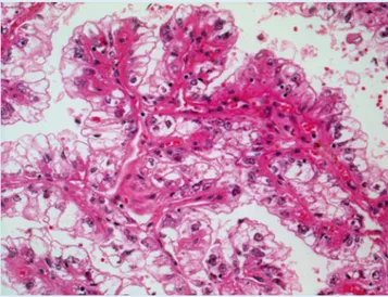 Abb. 1  8  Translokationskarzinom der Niere. Dieser Tumor tritt vorwiegend  im Kindesalter auf (HE-Färbung) Abb