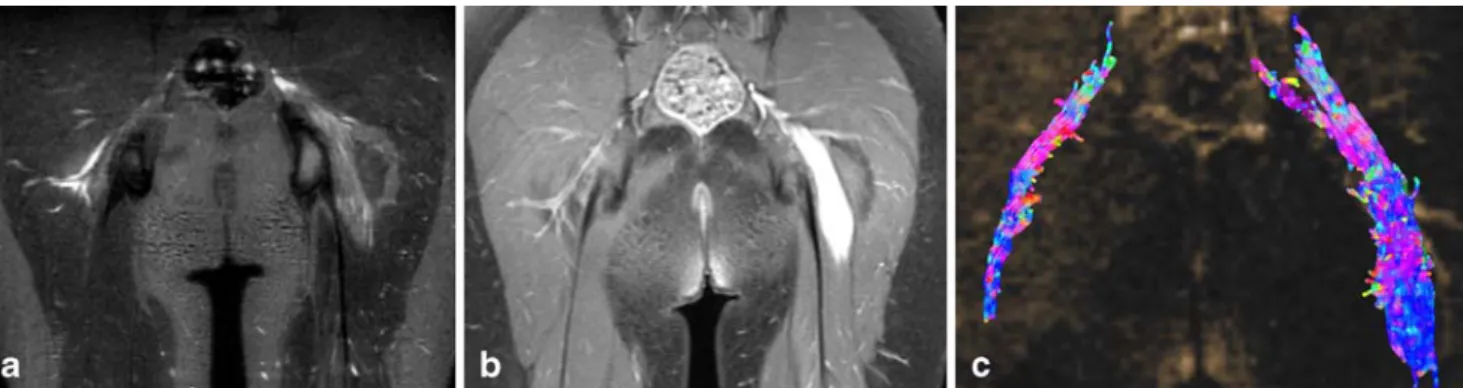 Fig. 2 Pathology. a Macroscop- Macroscop-ic view of the nerve trunk, with progressive diameter  enlarge-ment
