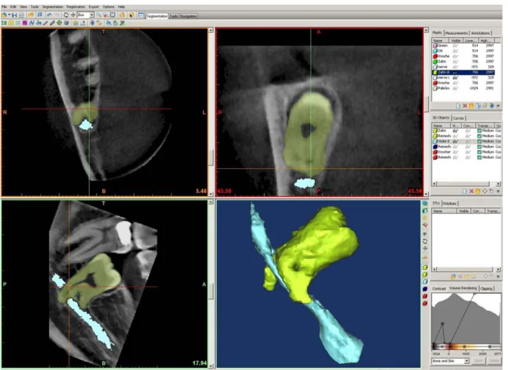 Fig. 2 The MIMICS software platform showing the 2D axial (upper left) coronal (upper right) and sagittal (lower left) dimensions with a mask for the gray values of the of the nervus alveolaris inferior (light