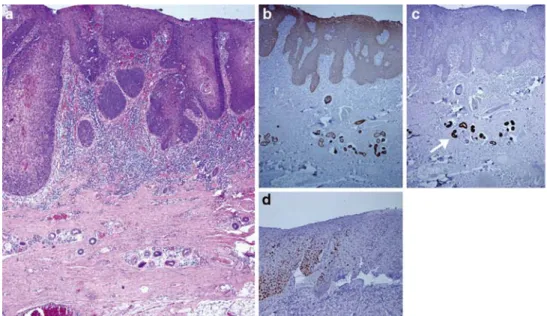 Fig. 1 Hematoxylin and eosin  (HE) staining of SCC arising in  the free forearm skin Xap of the  case no