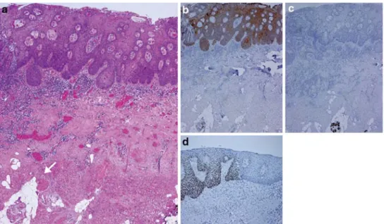 Fig. 2 HE staining of SCC aris- aris-ing in the deltopectoral skin Xap  of the case no