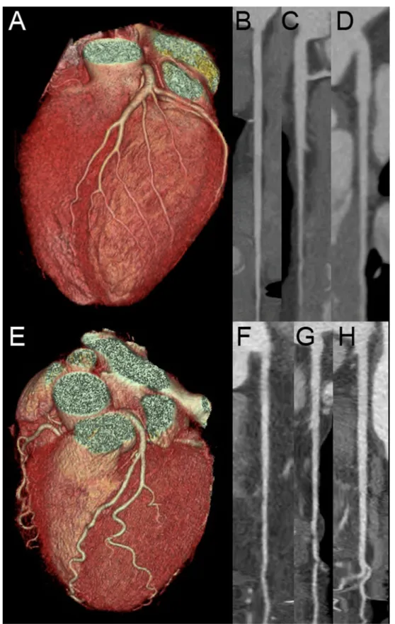 Fig. 1 Two matched patients with comparable image quality (image quality scores 1 or 2 in all coronary segments)