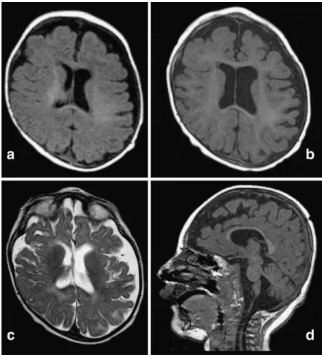 Fig. 1 Brain MRI of the patient at age 4 months (a) and 15 months