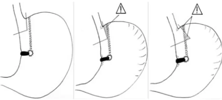 Fig. 1 Ideal placement of staple lines and places at risk from which a minimal distance must be preserved in order to avoid constructing a blind pouch