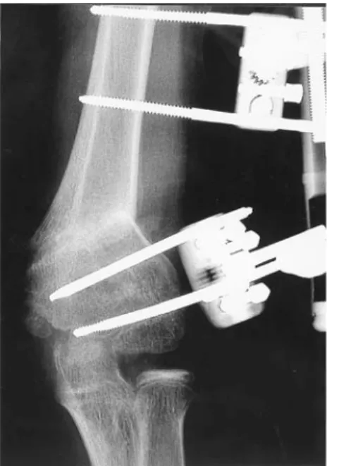 Figure 6. Lateral radiograph 6 weeks postoperatively. Flexion osteotomy corrected sagittal malunion.