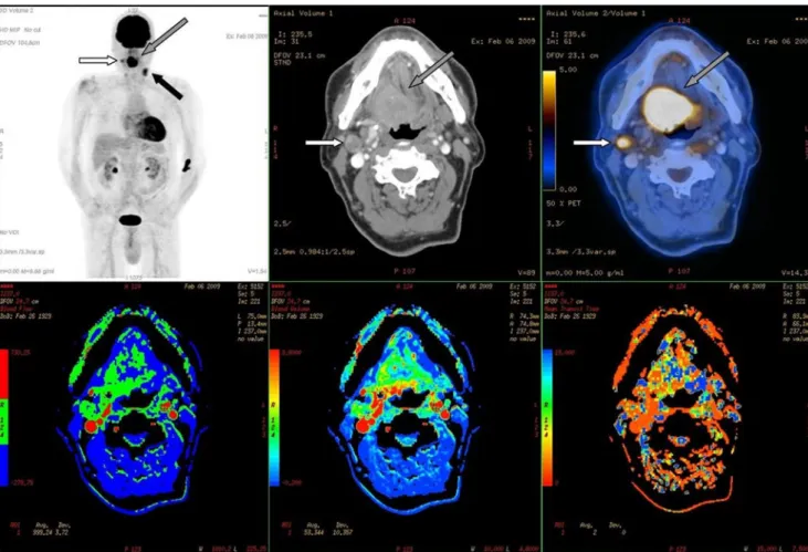 Fig. 2 Top row 3D MIP PET, axial contrast enhanced CT, axial contrast-enhanced PET/CT