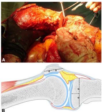 Fig. 4 The intact extensor mechanism with the frontal plane osteotomy through the patella (*) is seen after removal of the tumor specimen.