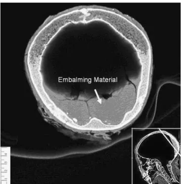 Fig. 2 Volume-rendered computed tomography image of the mummy skull depicts the potential of hard tissue discrimination.