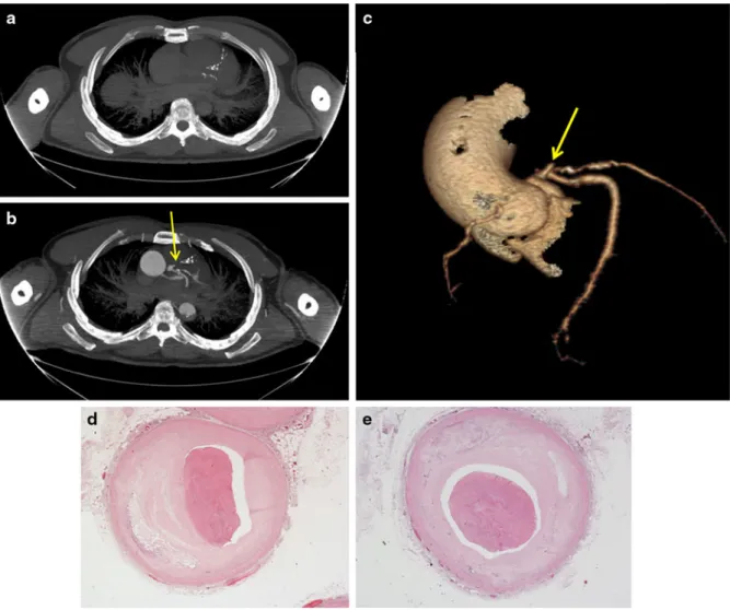 Fig. 3 Sudden collapse while driving in a 54 year old man (case no 20): native CT shows multiple calcifications of LAD (a), angio-CT (b, c) calcifications and an occlusion (arrow) of