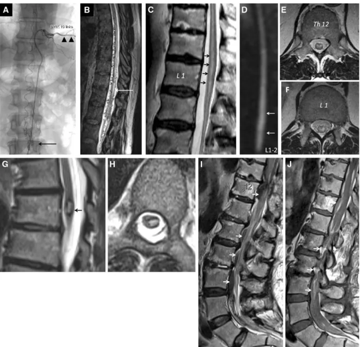 Figure 1. a b A 50-year-old man with recurrent extensive spinal intradural arteriovenous malformation