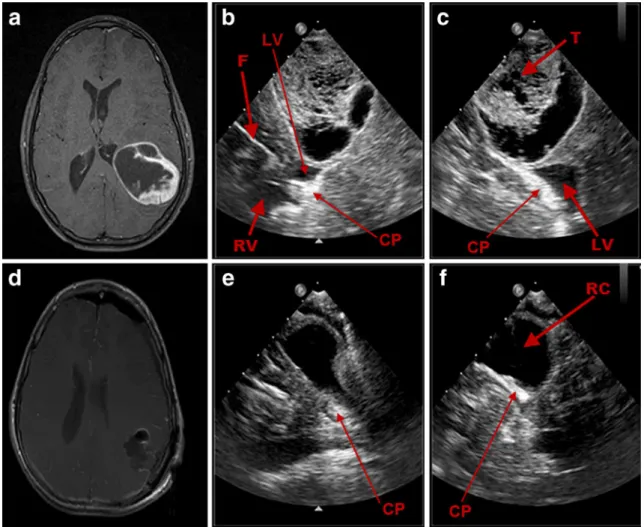 Fig. 1 Illustrative case no. 1 (case 13, L.D.): preoperative axial T1 MRI with contrast (a) of a 15-year-old male patient with a left parietal atypical pilocytic astrocytoma and the corresponding RT-3-D IOUS images in “ X-Plane ” mode as shown in the coron